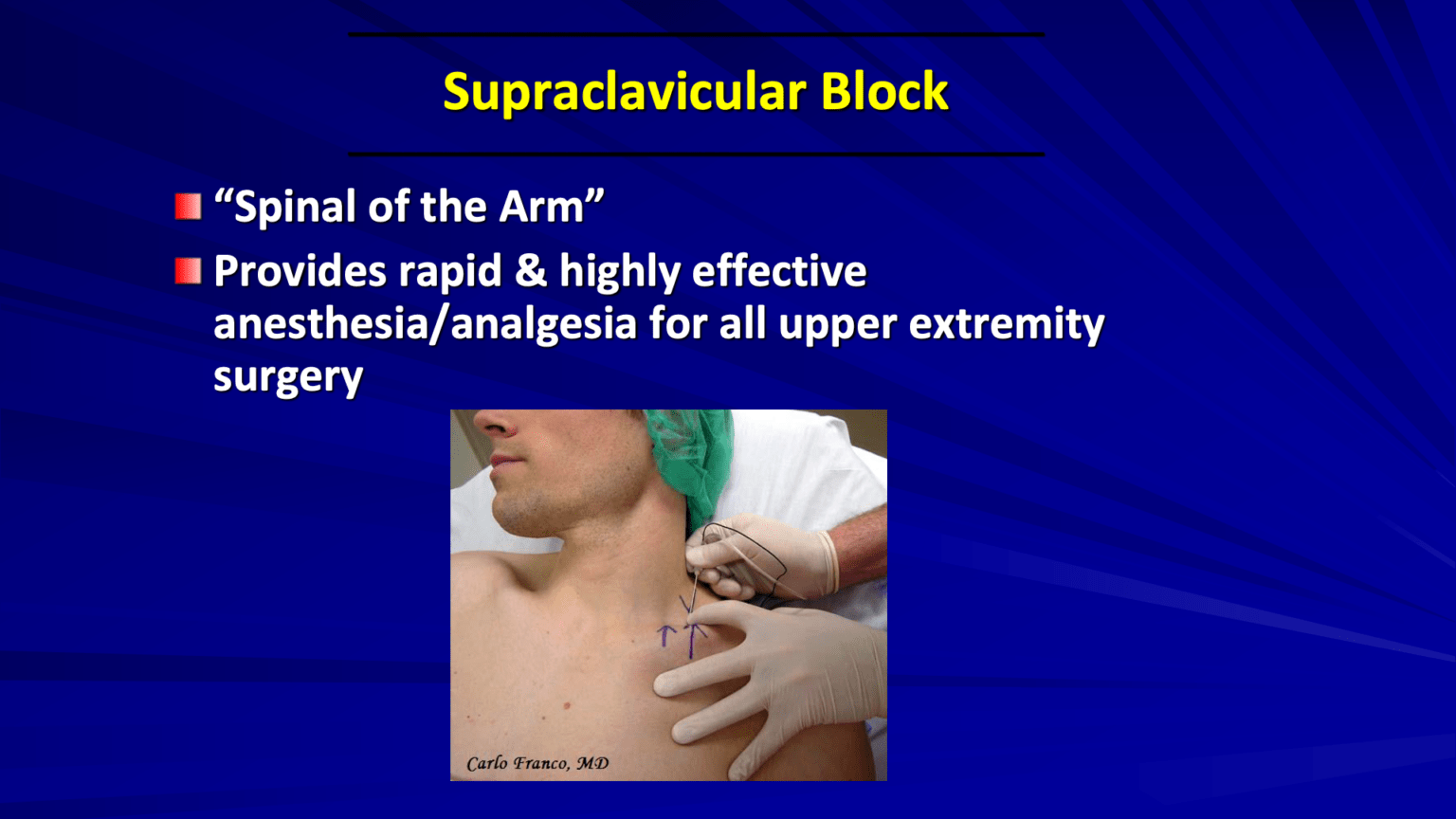[VIDEO] Is the Supraclavicular Plexus Block the Right Choice to Prevent