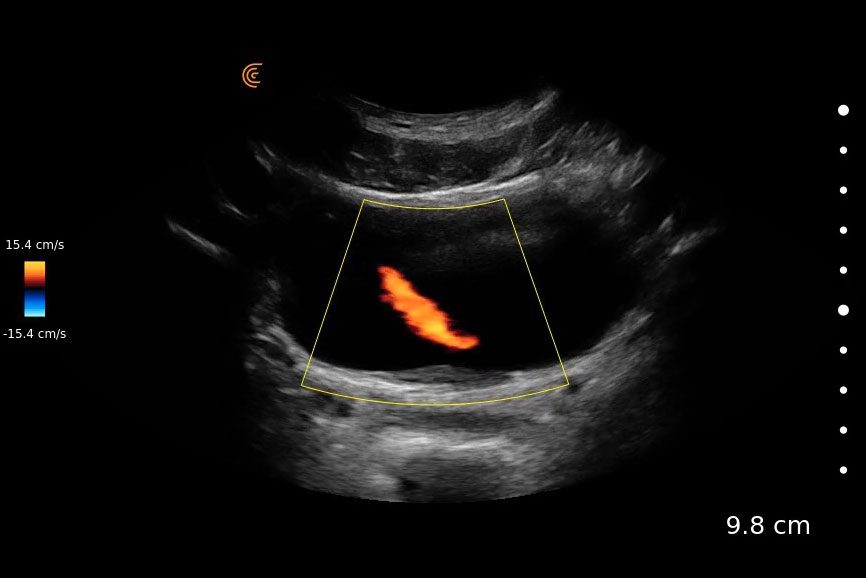 Bilateral Urine Jets Clarius