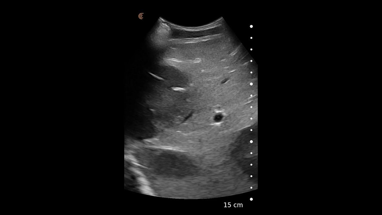 Liver Metastases Clarius