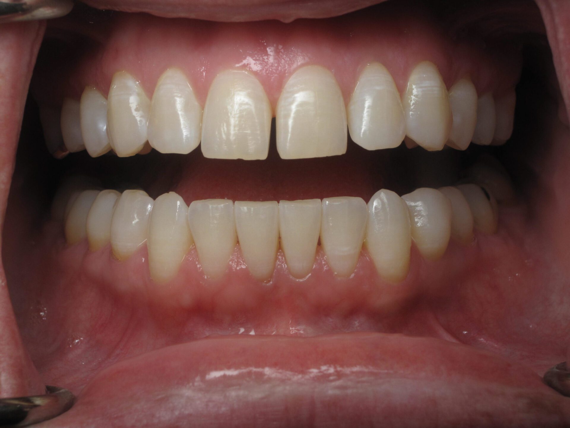 Before And After Clark Family Dentistry