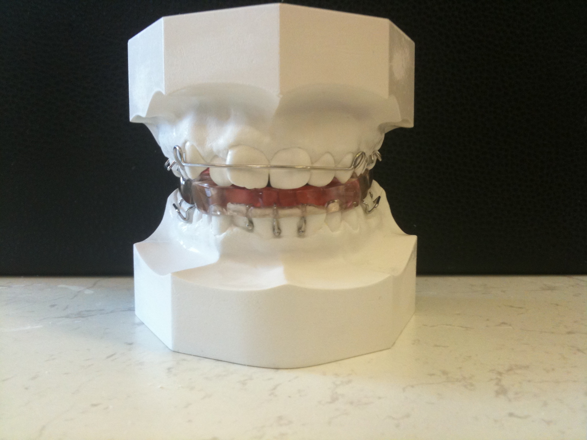 Twin Block on SM « Classone Orthodontics