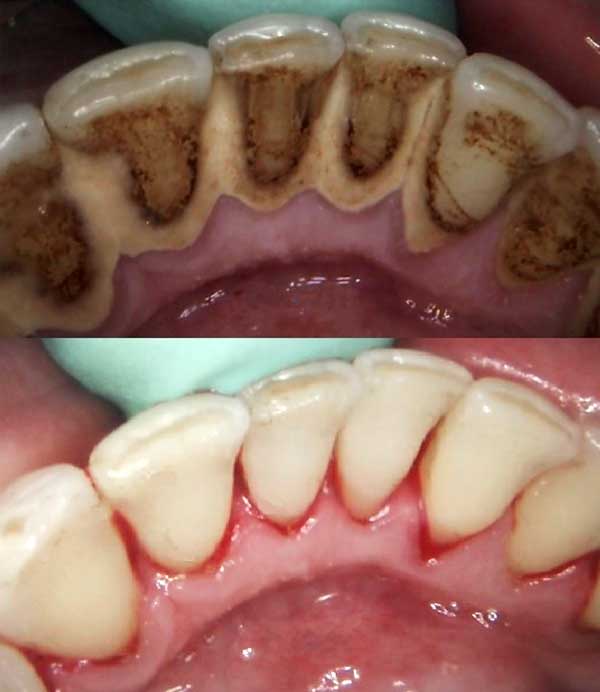 Dental Trick to Rebuild Your Teeth and Gums And Get Rid of