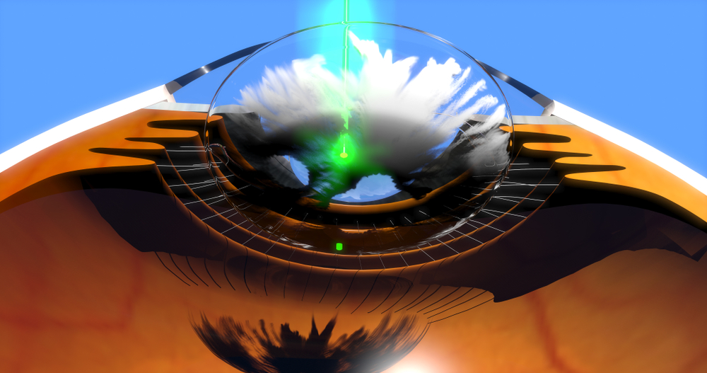 YAG Capsulotomy Laser Surgery Morrow Other Surgeries