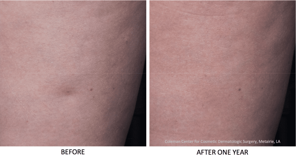 Cellulite Reduction Treatments by San Diego Specialists