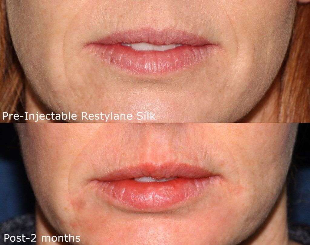 Restylane Silk San Diego, CA Cosmetic Laser Dermatology