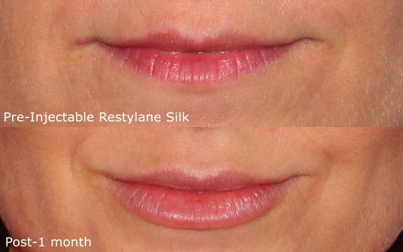 Restylane Silk Lip Filler Medi Spa San Diego, CA CLDerm