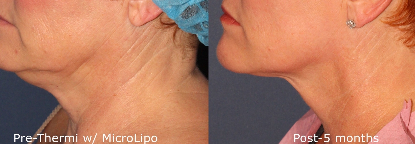 Thermi Skin Tightening Treatment San Diego, CA CLDerm