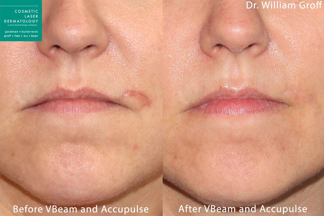 Scar & Acne Scar Treatment Med Spa San Diego, CA CLDerm