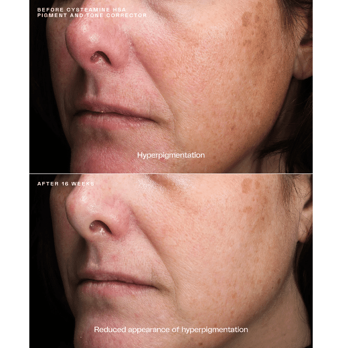 SENTÉ Cysteamine HSA Pigment & Tone Corrector Cosmetic Laser
