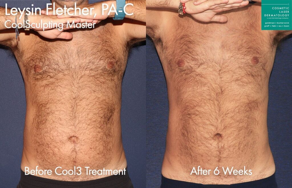 Coolsculpting for Men San Diego, CA Cosmetic Laser Dermatology