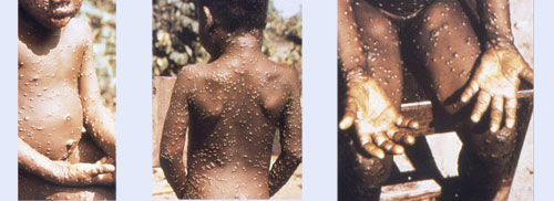 Monkey Pox - monkeypox hits lagos