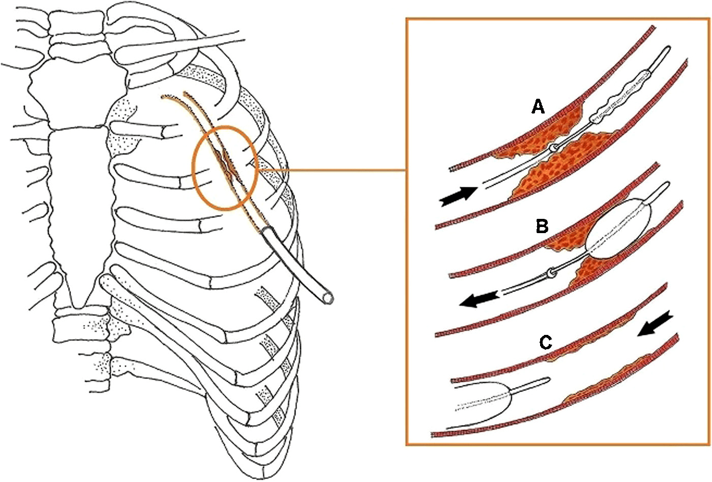 Open Chest Tube Clearance of Clot Is it safe? Is there a better way