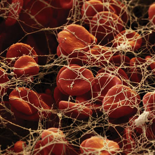 Bleeding after heart surgery Better out than in! Clearflow