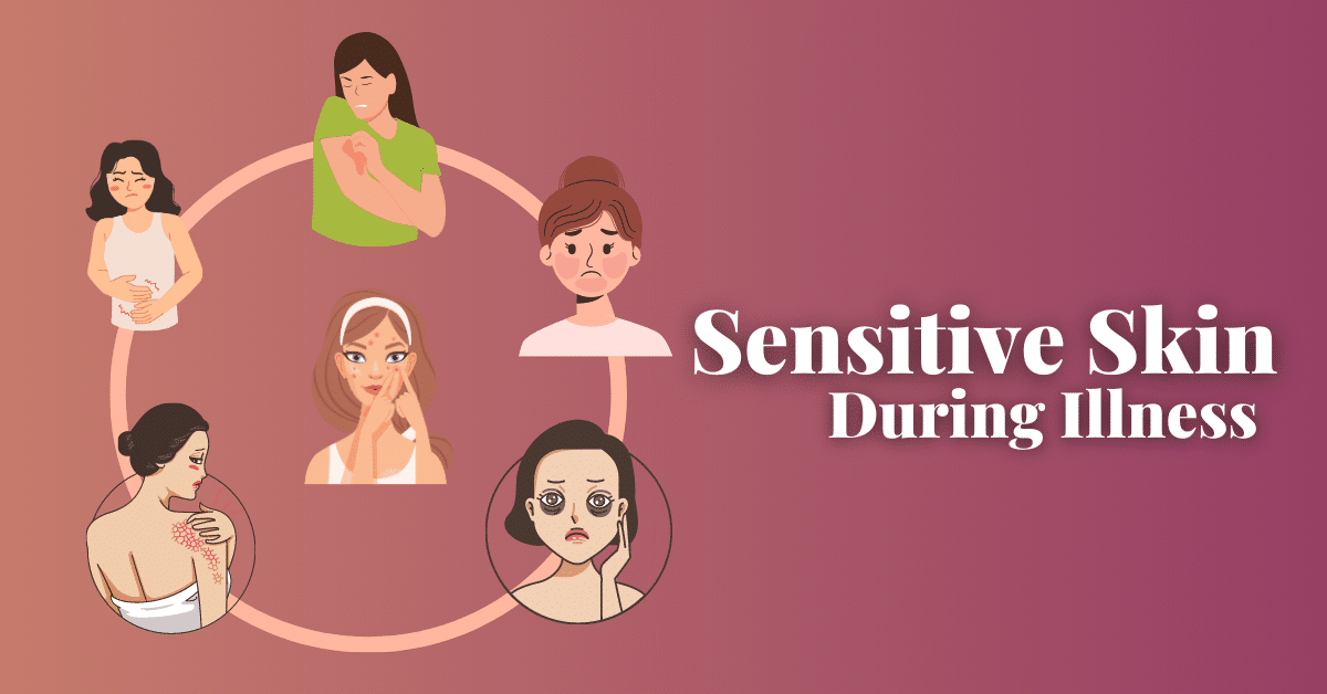 Sensitive Skin During Illness Causes, Symptoms, And Home Remedies