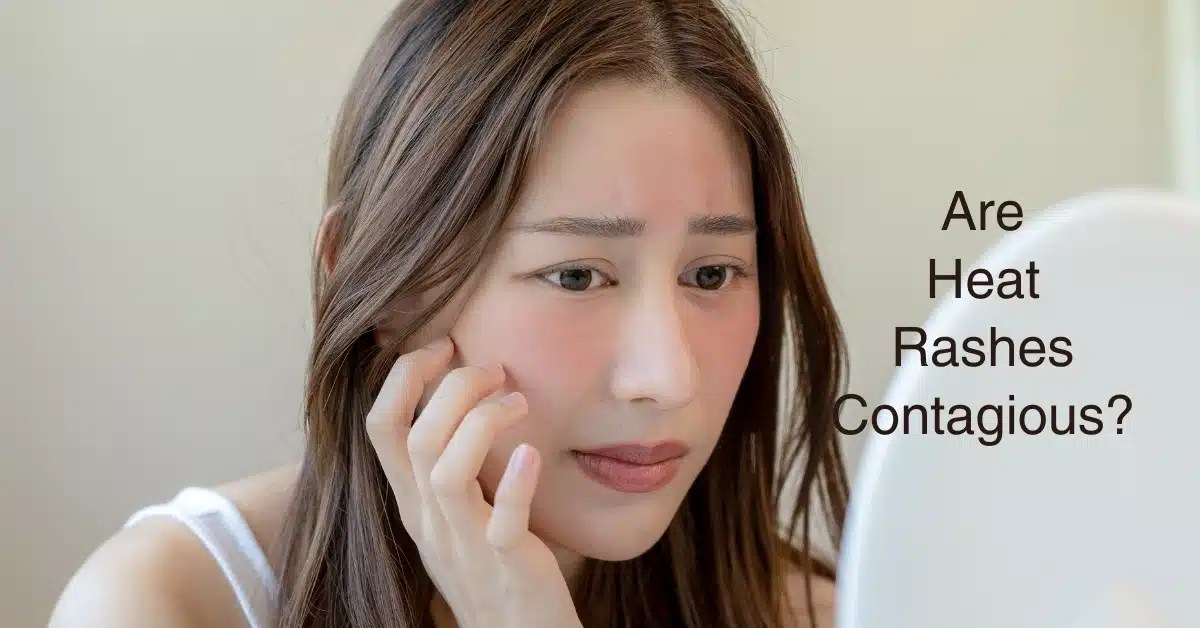 Are Heat Rashes Contagious? Unveiling The Truth For Clear And Happy