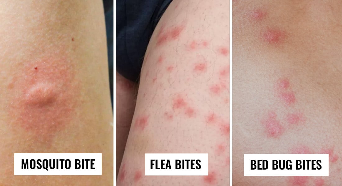 Bed Bug Bites Identification, Prevention & Treatment