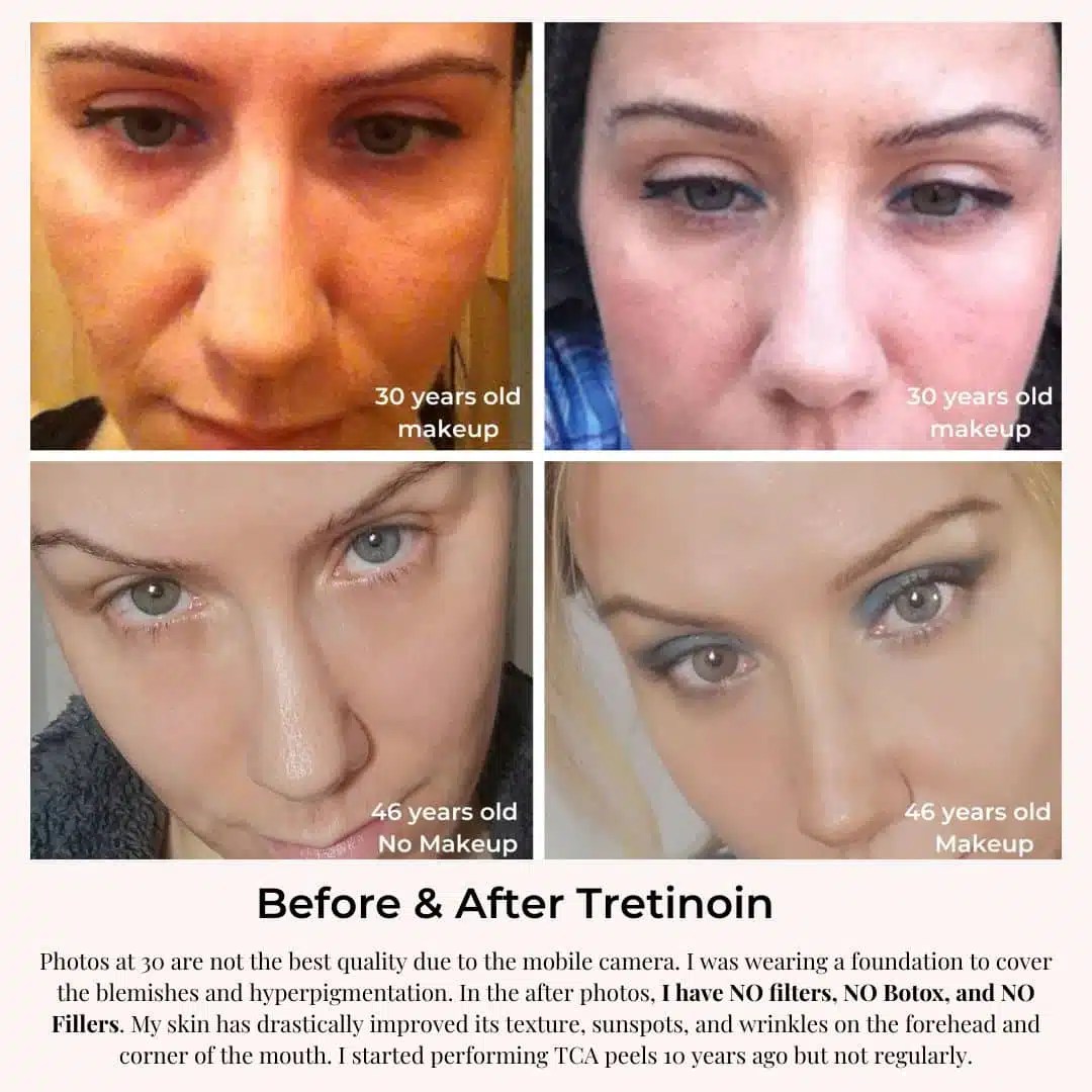 RETINA / Tretinoin For Wrinkles Review & Before and After!