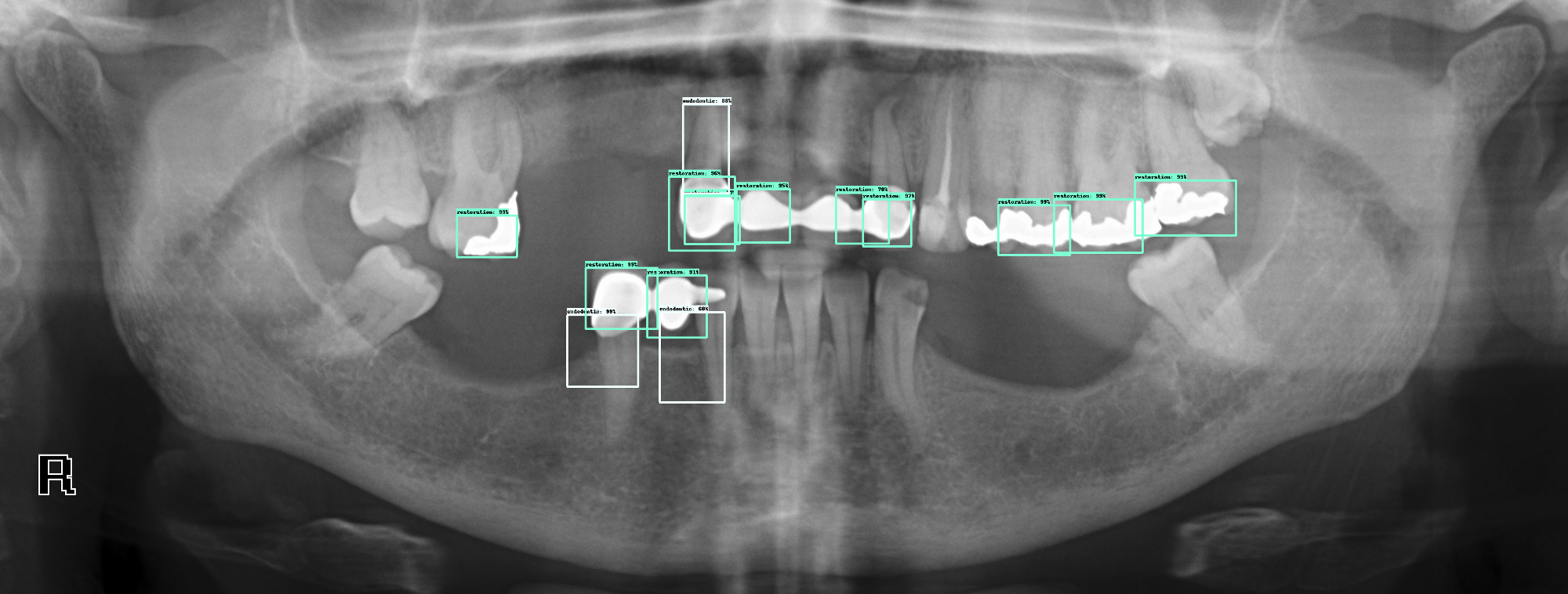 Deep learning object detection on dental xrays Clement Joudet blog
