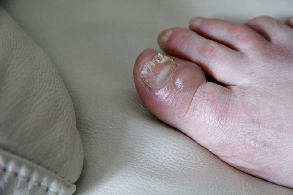 Comment éviter les ampoules aux pieds ? PECHE ET SAC A DOS