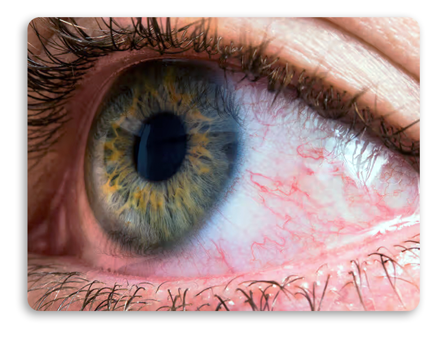 Eye Conditions Clervision