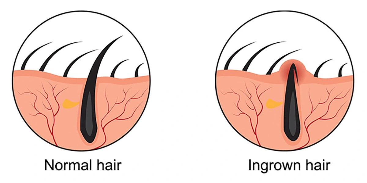What Are Ingrown Hairs and How to Prevent Them Click Shave