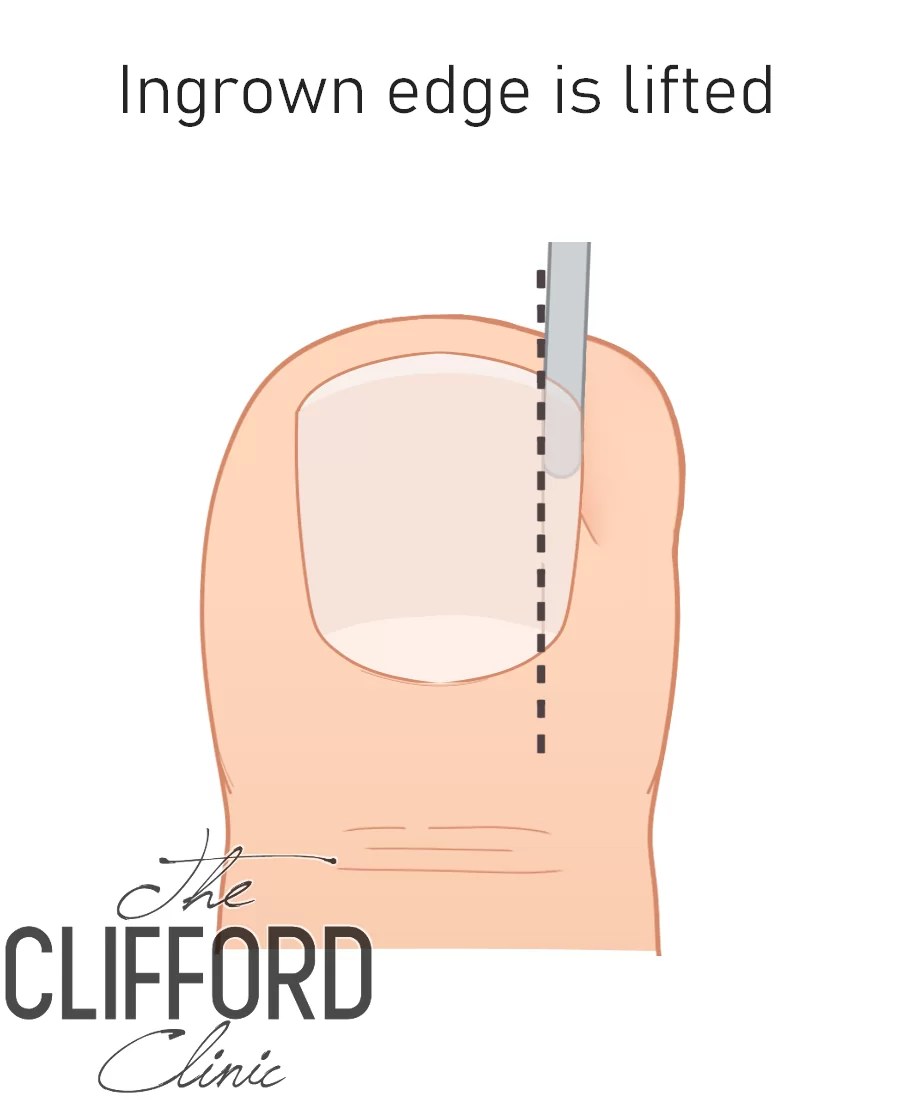 Partial Nail Avulsion Ingrown Toenailremovalsurgery