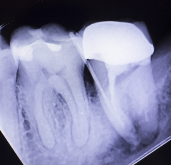 Pediatric Dental Xrays in Chapel Hill Clifton & Mauney