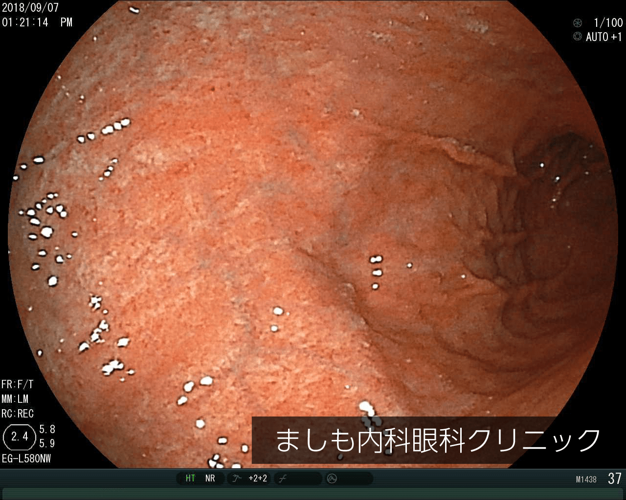 萎縮性胃炎 Atrophic gastritis JapaneseClass.jp