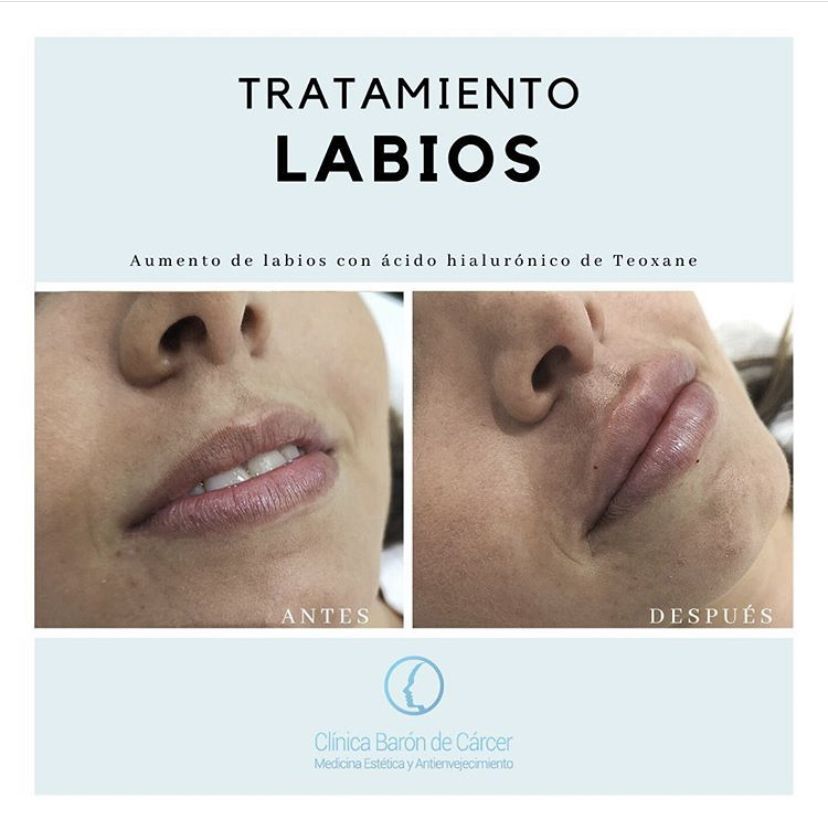 Antes y despues Aumento de labios con ácido hialurónico