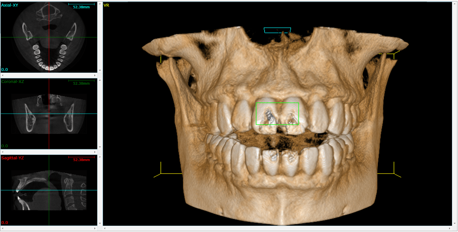 Dental CT help in personification of treatments Clínica Blasi