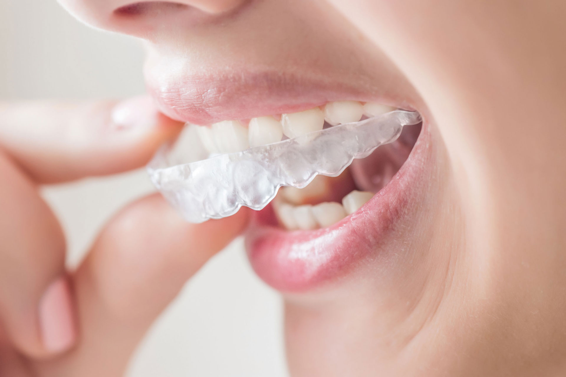 La ortodoncia invisalign ¿Diferencias entre la Lite y la Full