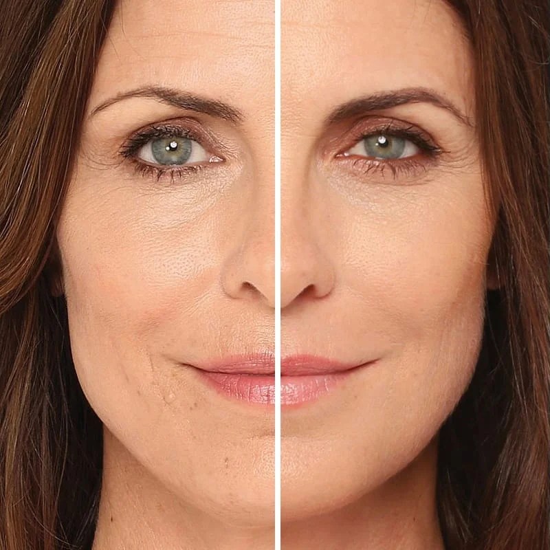 Relleno facial con Radiesse Clínica Ciudad Mar