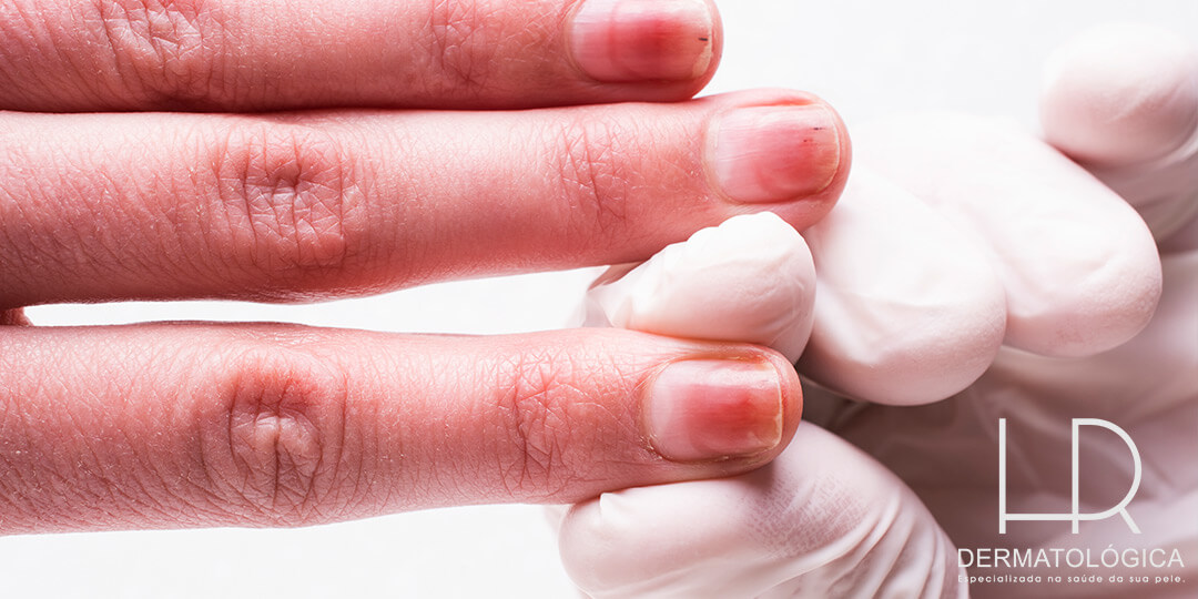 Doenças das unhas HR