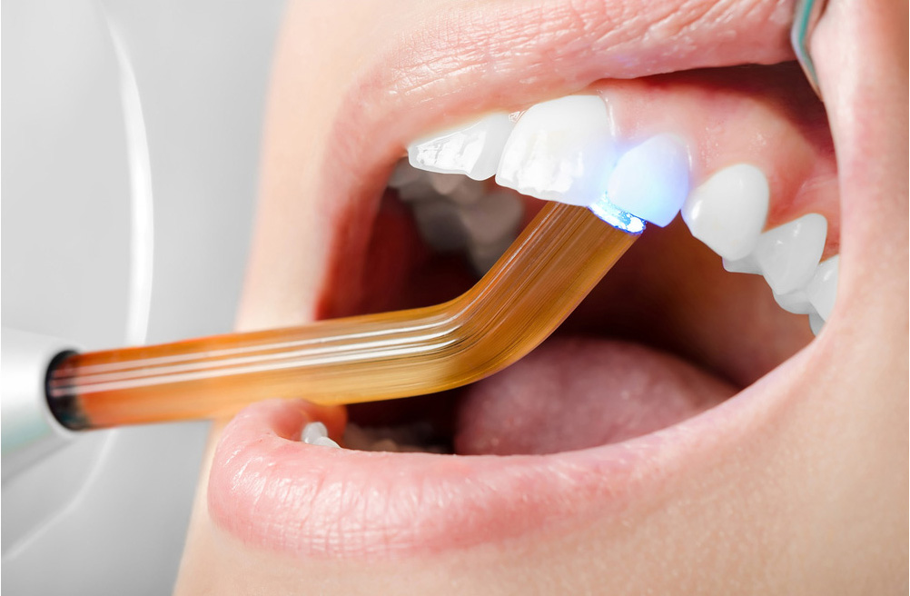 ¿SE PUEDE COMER DESPUÉS DE UN EMPASTE? Clínica Javier Morillo