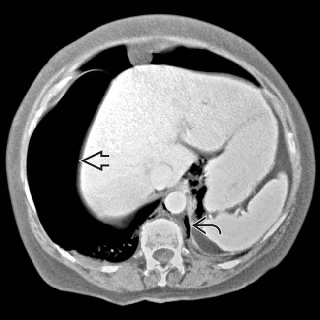Barotrauma Clinical Gate