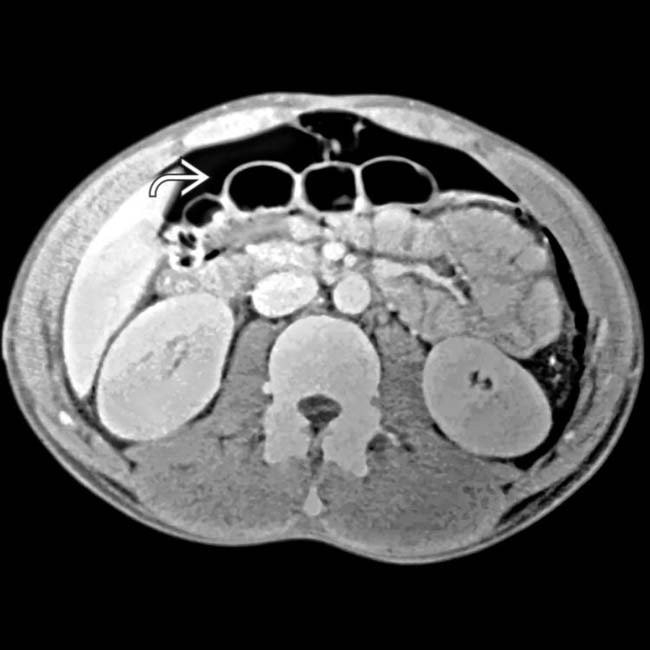 Barotrauma Clinical Gate