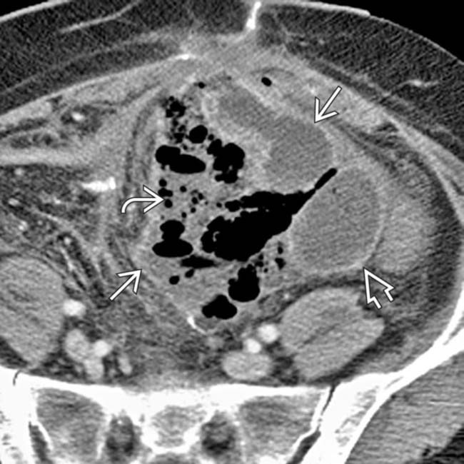 Abdominal Abscess Clinical Gate