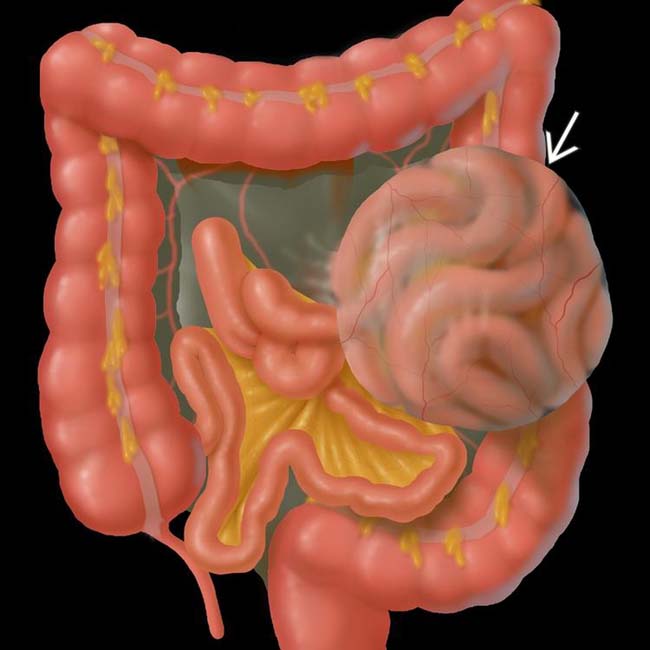 Paraduodenal Hernia Clinical Gate