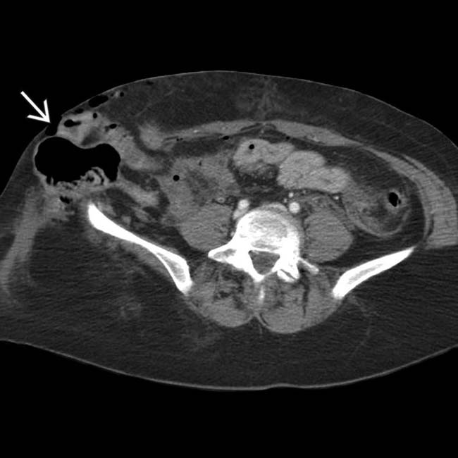 Traumatic Abdominal Wall Hernia Clinical Gate