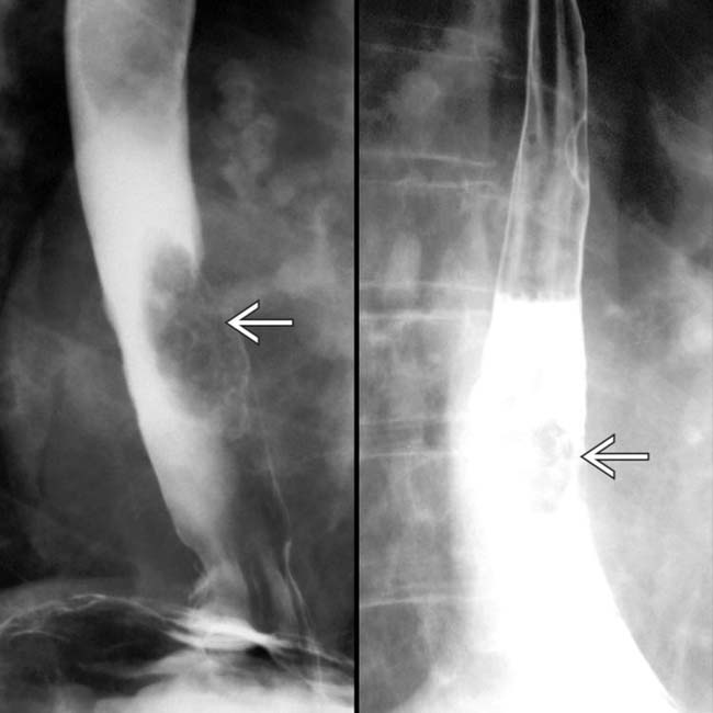 Barrett Esophagus Clinical Gate