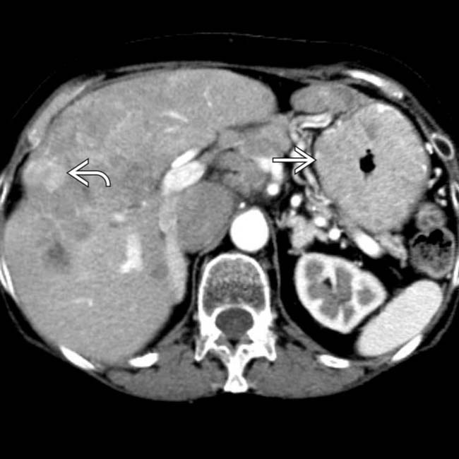 ZollingerEllison Syndrome Clinical Gate