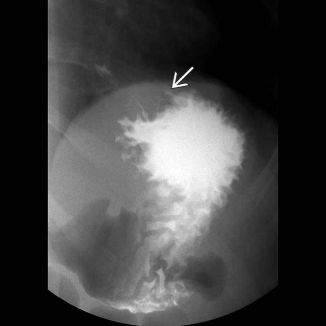Fundoplication Complications Clinical Gate