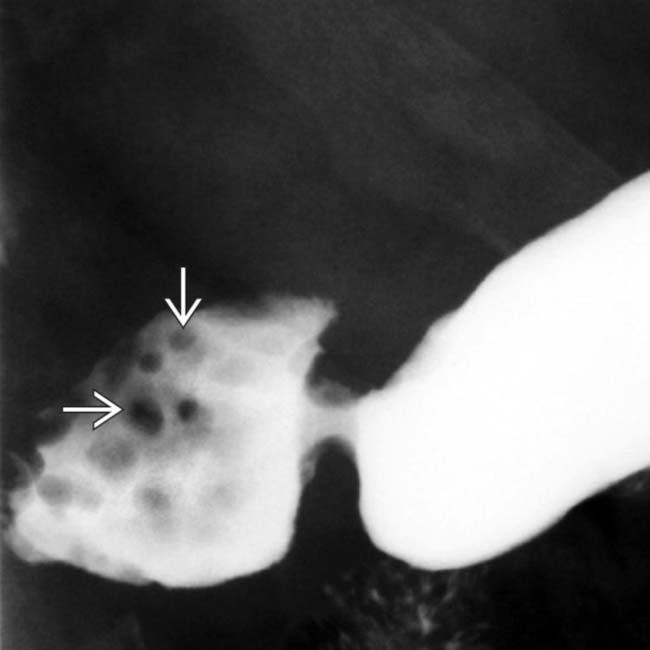 Brunner Gland Hyperplasia Clinical Gate