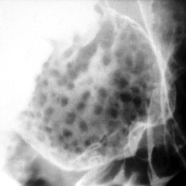 Brunner Gland Hyperplasia Clinical Gate