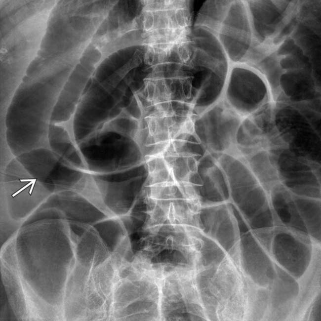 Ileus Clinical Gate