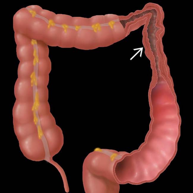 Ischemic Colitis Clinical Gate