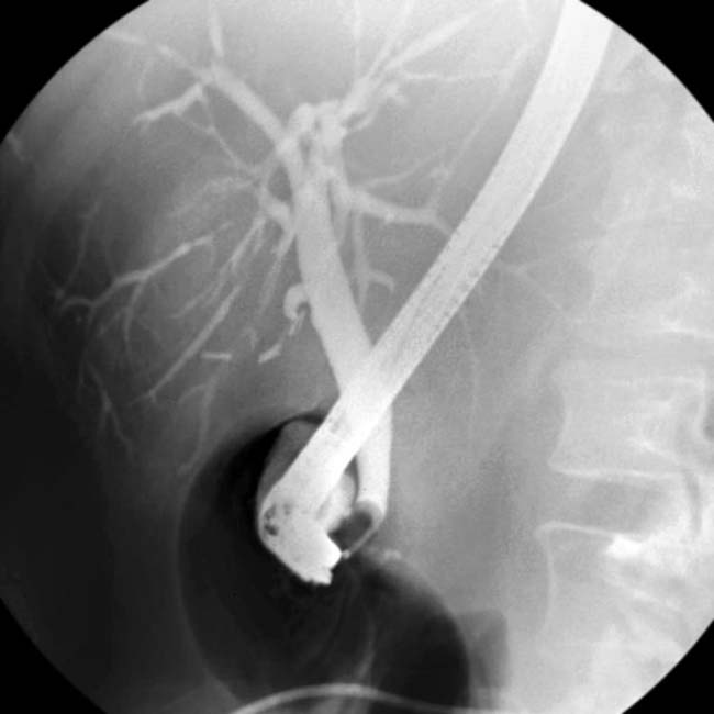 AIDS Cholangiopathy Clinical Gate