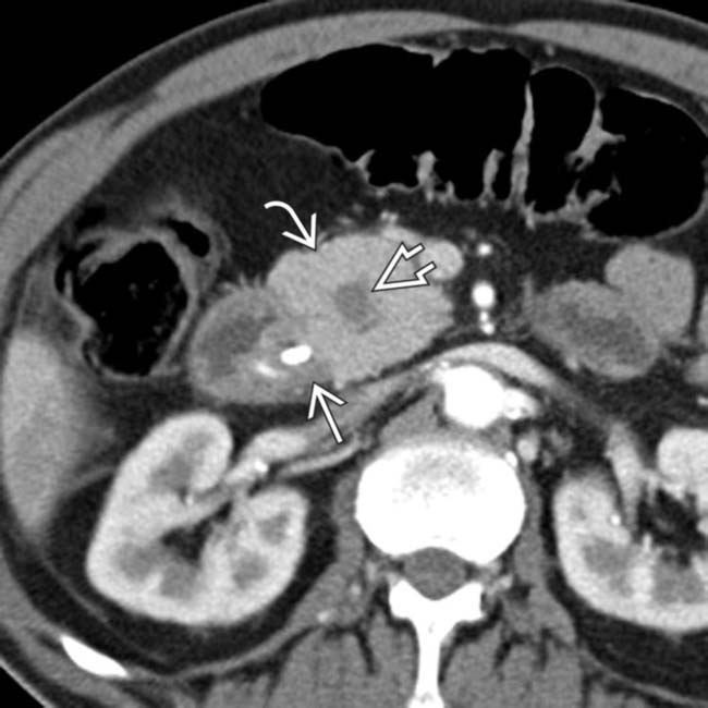 Groove Pancreatitis Clinical Gate