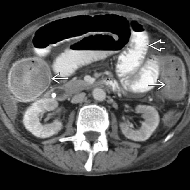 Toxic Megacolon Clinical Gate