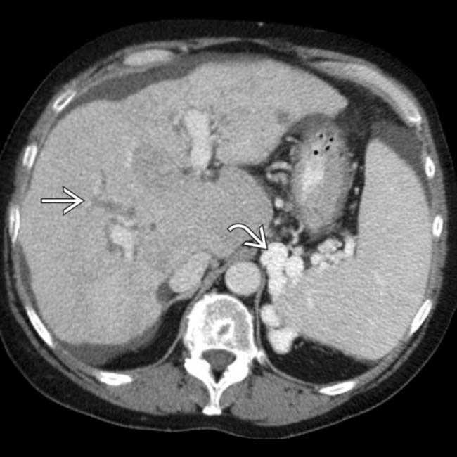 Autoimmune Hepatitis Clinical Gate